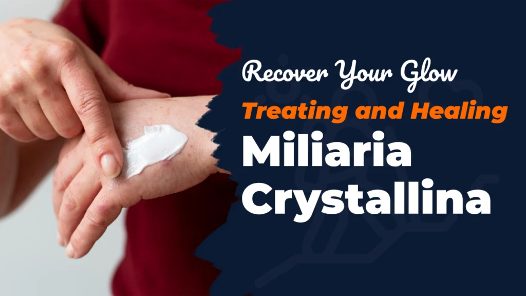 Recover Your Glow: Treating and Healing Miliaria Crystallina